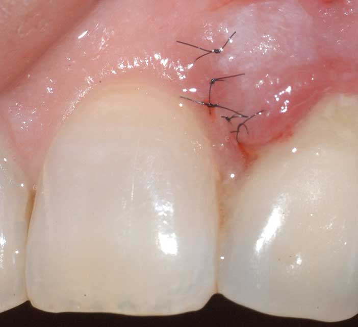 Presque 53000 publications répertoriées en 2015 sur PubMed concernant le term minimally invasive depuis 1992. Une croissance exponentielle de l’intérêt porté par ce sujet en médecine. La dentisterie n’échappe pas à ce mouvement : le LASER Er-Yag lui permet de franchir une étape de plus dans cette voie.